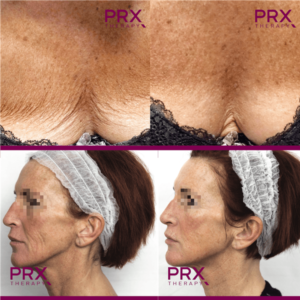 PRX-T33 5x4ml WiQo | Peeling Biorevitalisation – Image 2
