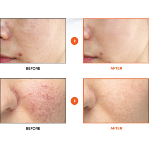 hanheal-nad-+-complex-skinpulp-skinbooster-exosome